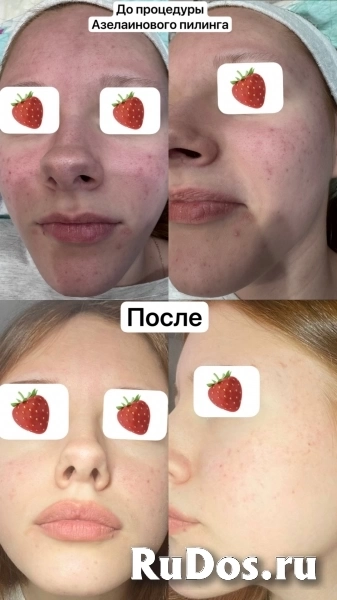 Чистка лица фотка