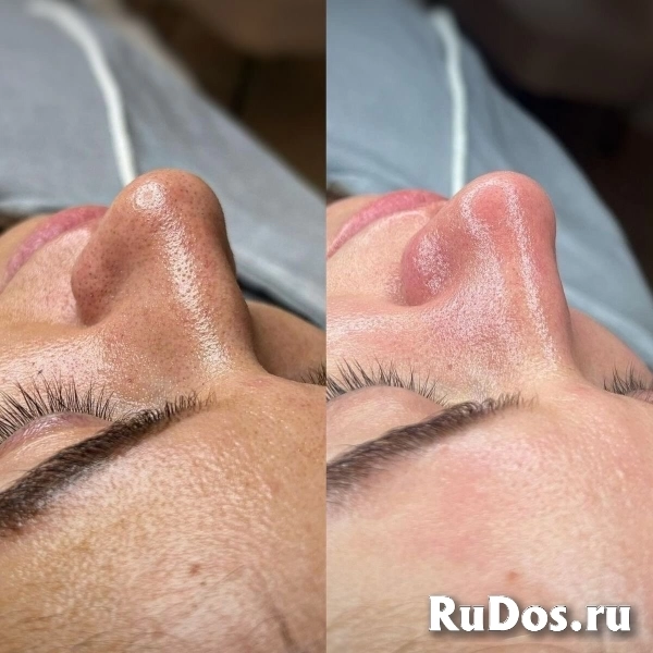 Чистка лица изображение 9