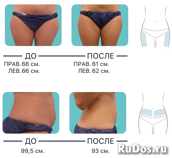Криополиз - похудение без диет: уберём жировые клетки, восстановим мышцы фото