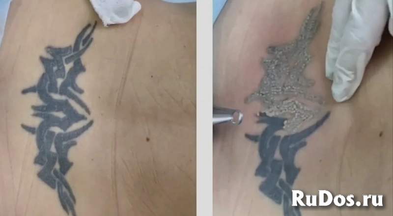 Удаление тату лазером изображение 3