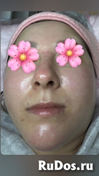 Чистка лица изображение 7
